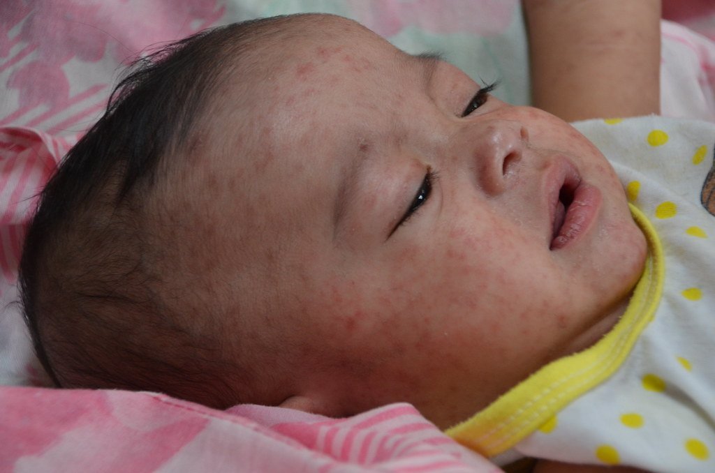 image Measles toddler ‘out of danger’
