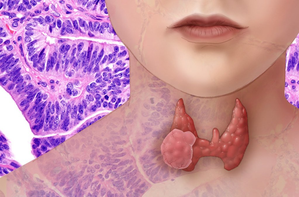 cover Thyroid second most common cancer in women