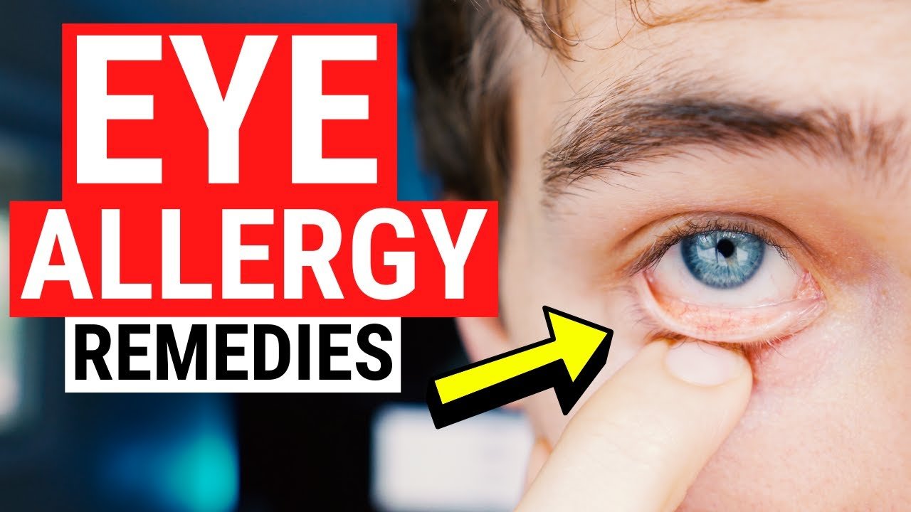 cover Eye allergy remedies &#8211; tips for itchy and watery eyes