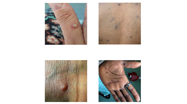 pictures showing examples of rashes and lesions caused by the monkeypox virus