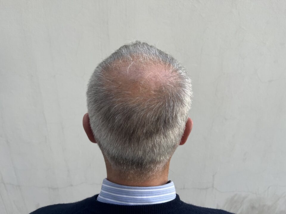 Debunking 4 myths about hair transplants | Cyprus Mail