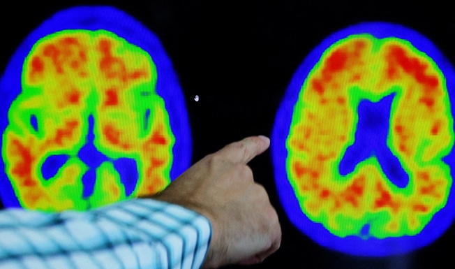 image Acumen&#8217;s Alzheimer&#8217;s drug passes initial safety test