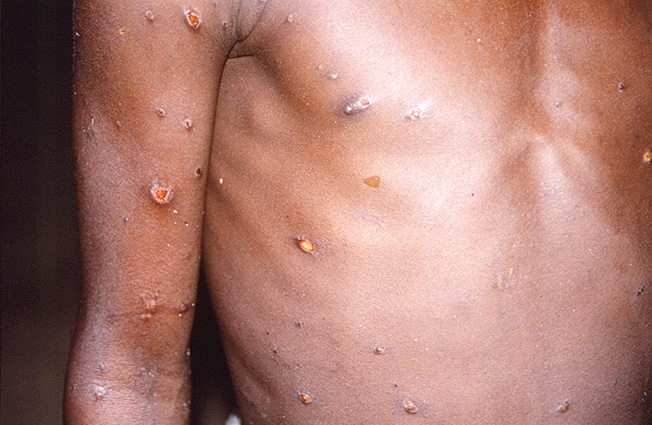 image WHO urges gay men to get mpox vaccine as European cases rise