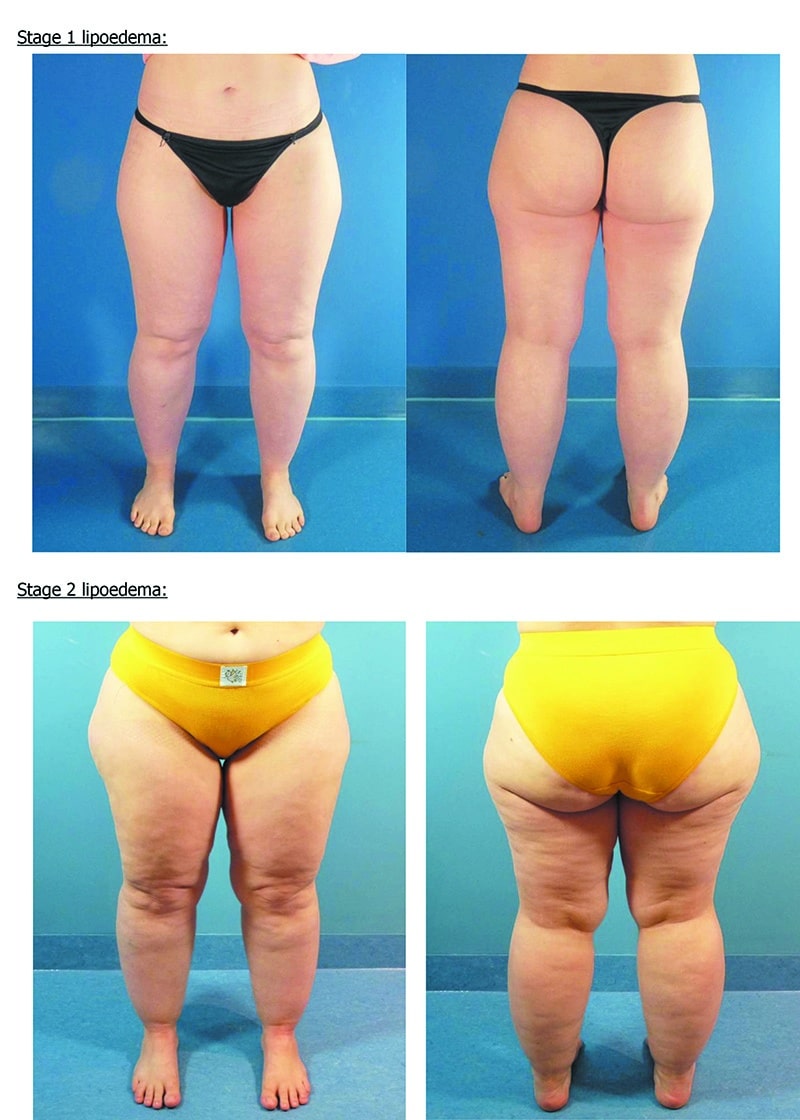 lipedema and it therapy in cyprus