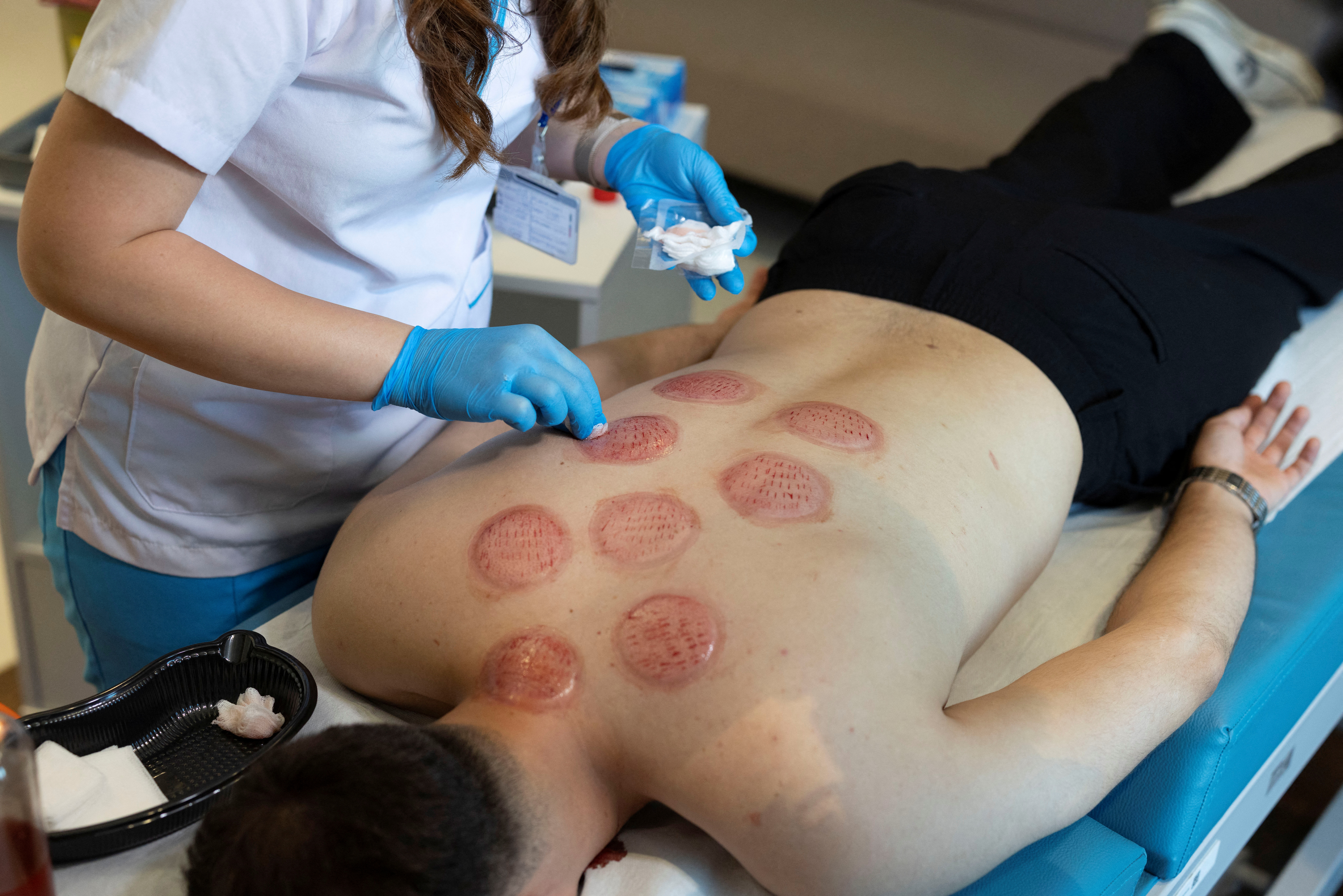 image Cupping, leeching and other ancient healing methods welcomed in Turkish hospitals