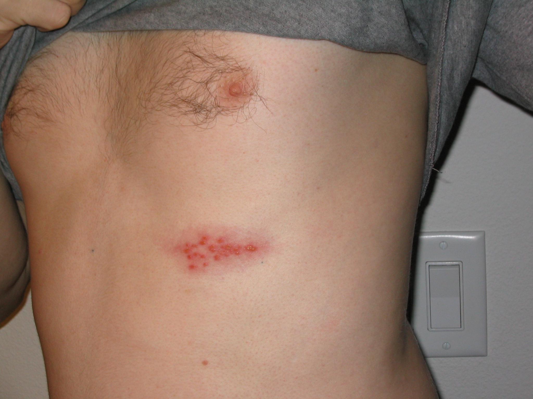 image ‘Take shingles seriously’ Gesy urges public