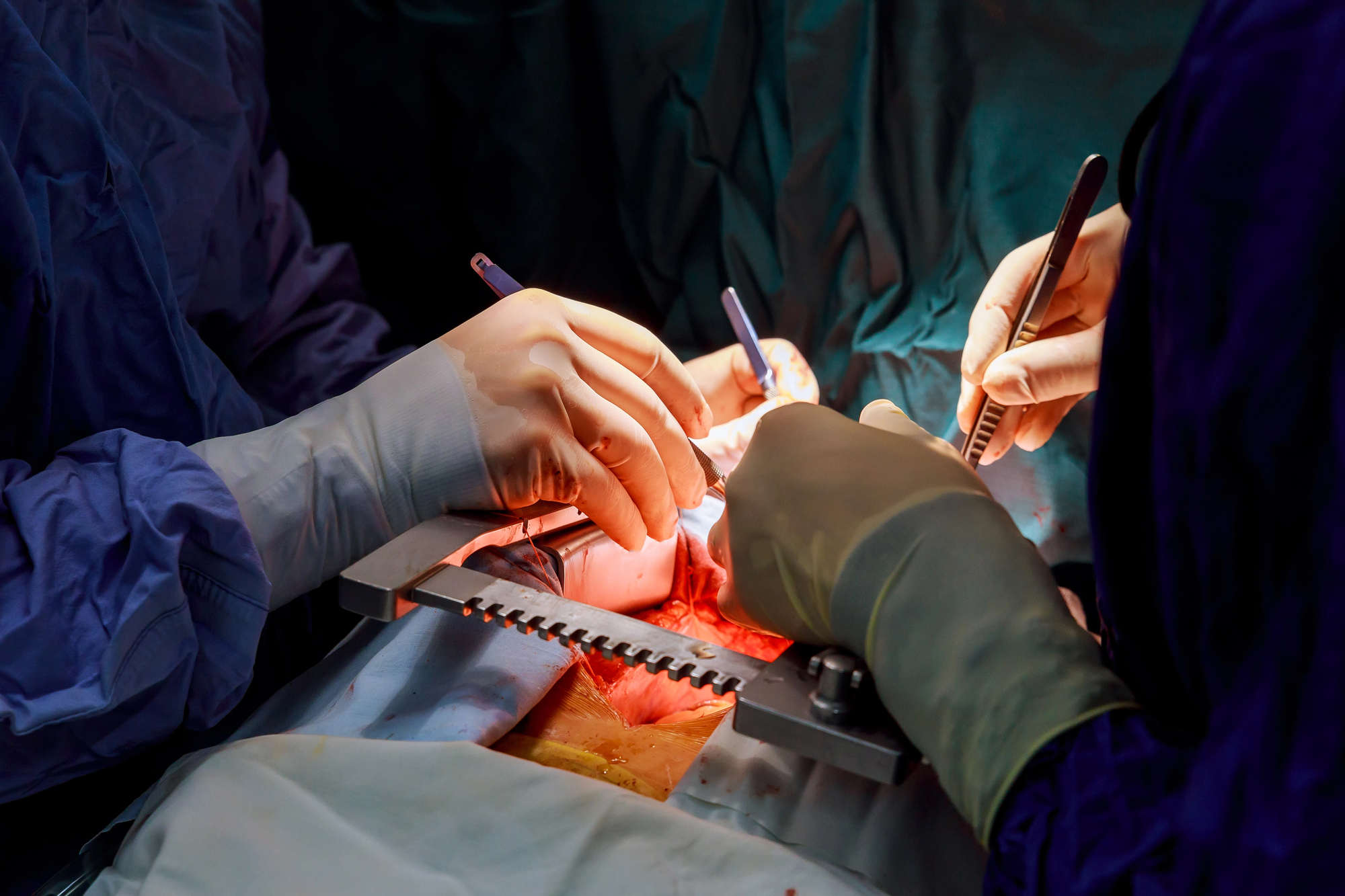 cover First human coronary bypass surgery performed without chest cracking